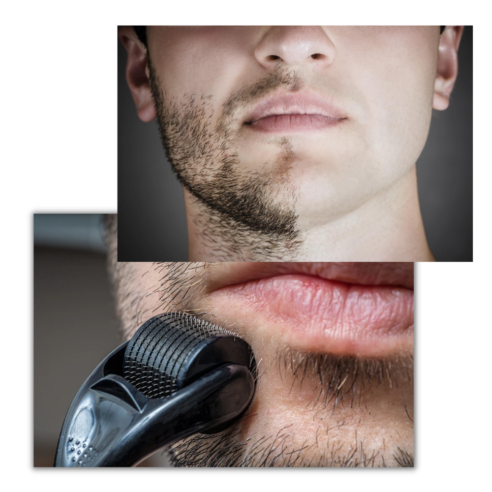 Dermal Roller For Hair And Beard Growth